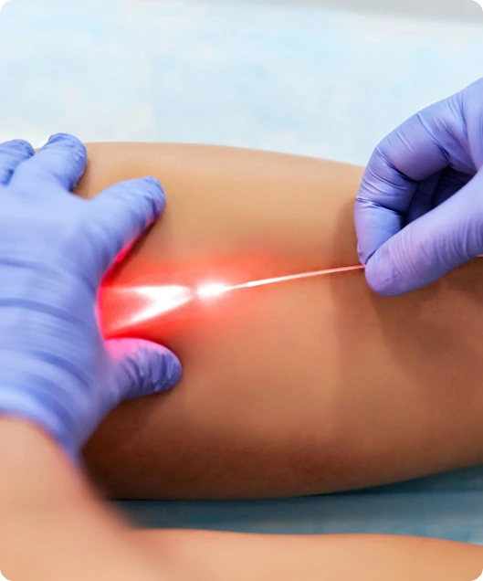 What Is Endovenous Laser Ablation? Banner