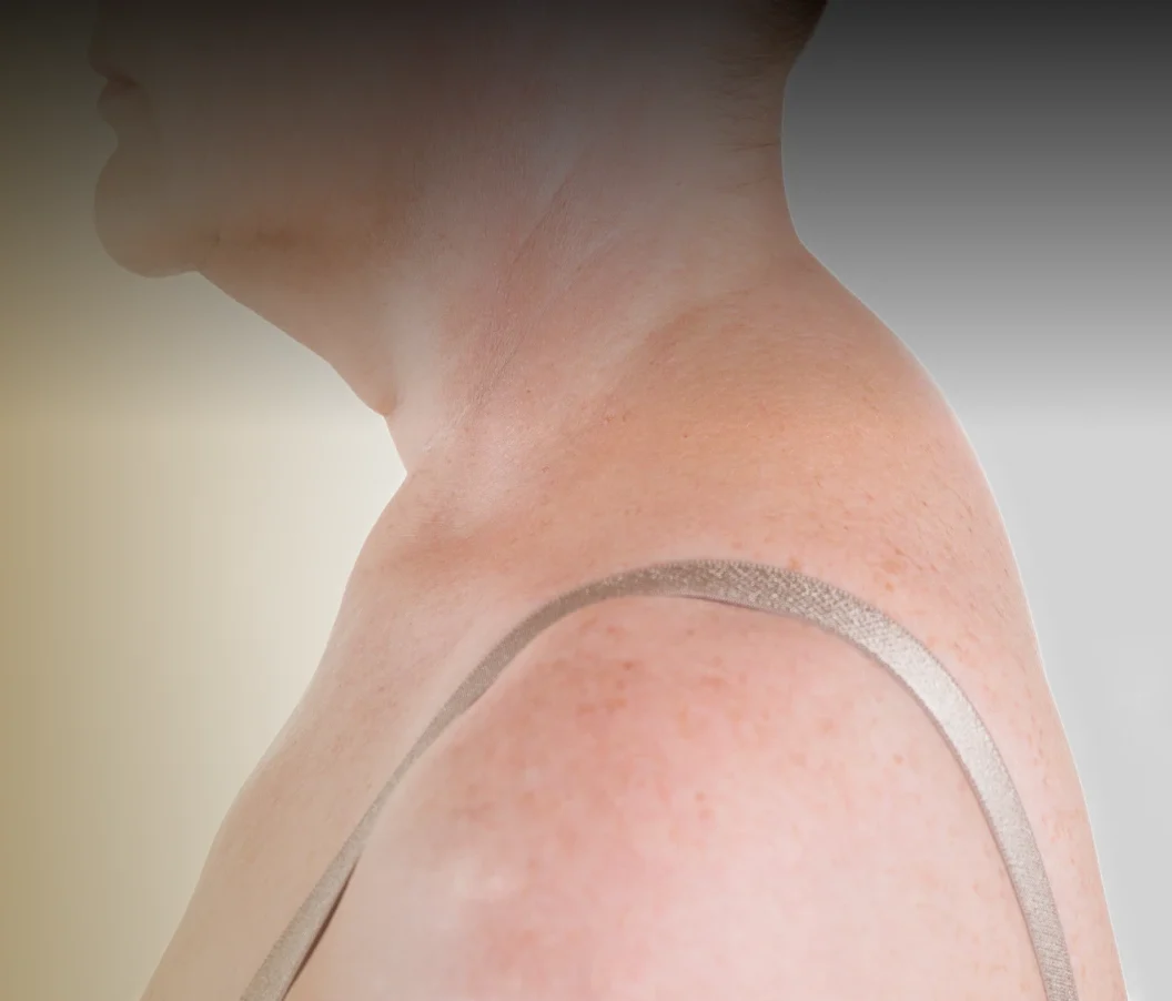Buffalo Hump Liposuction in Springfield, MO Banner