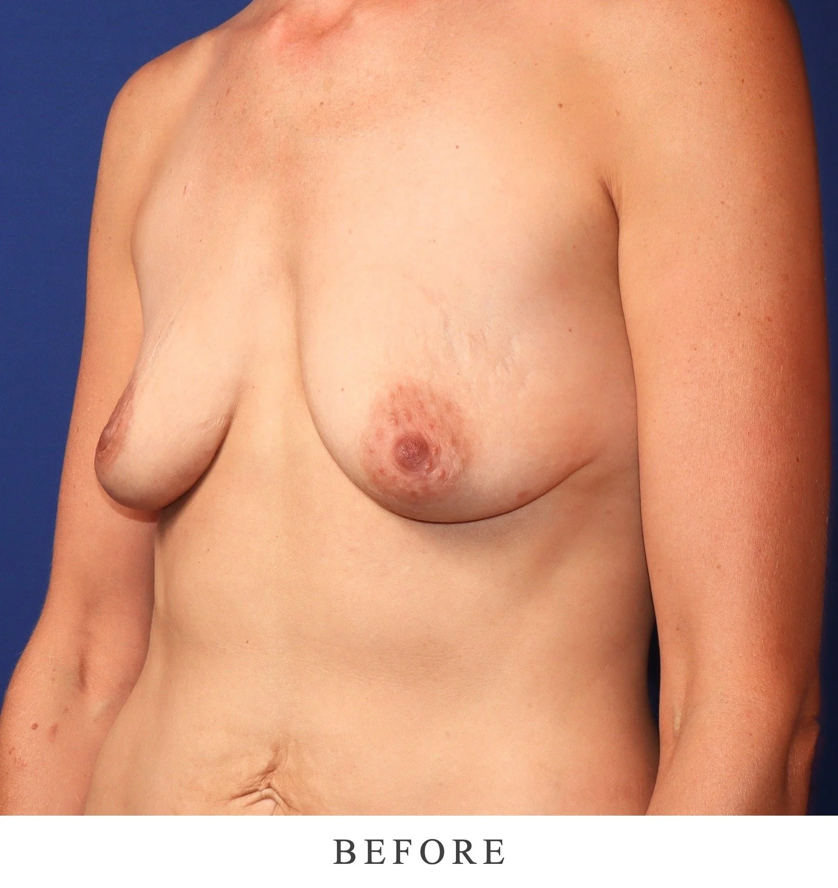 Before breast surgery photo showing patient's torso against blue background