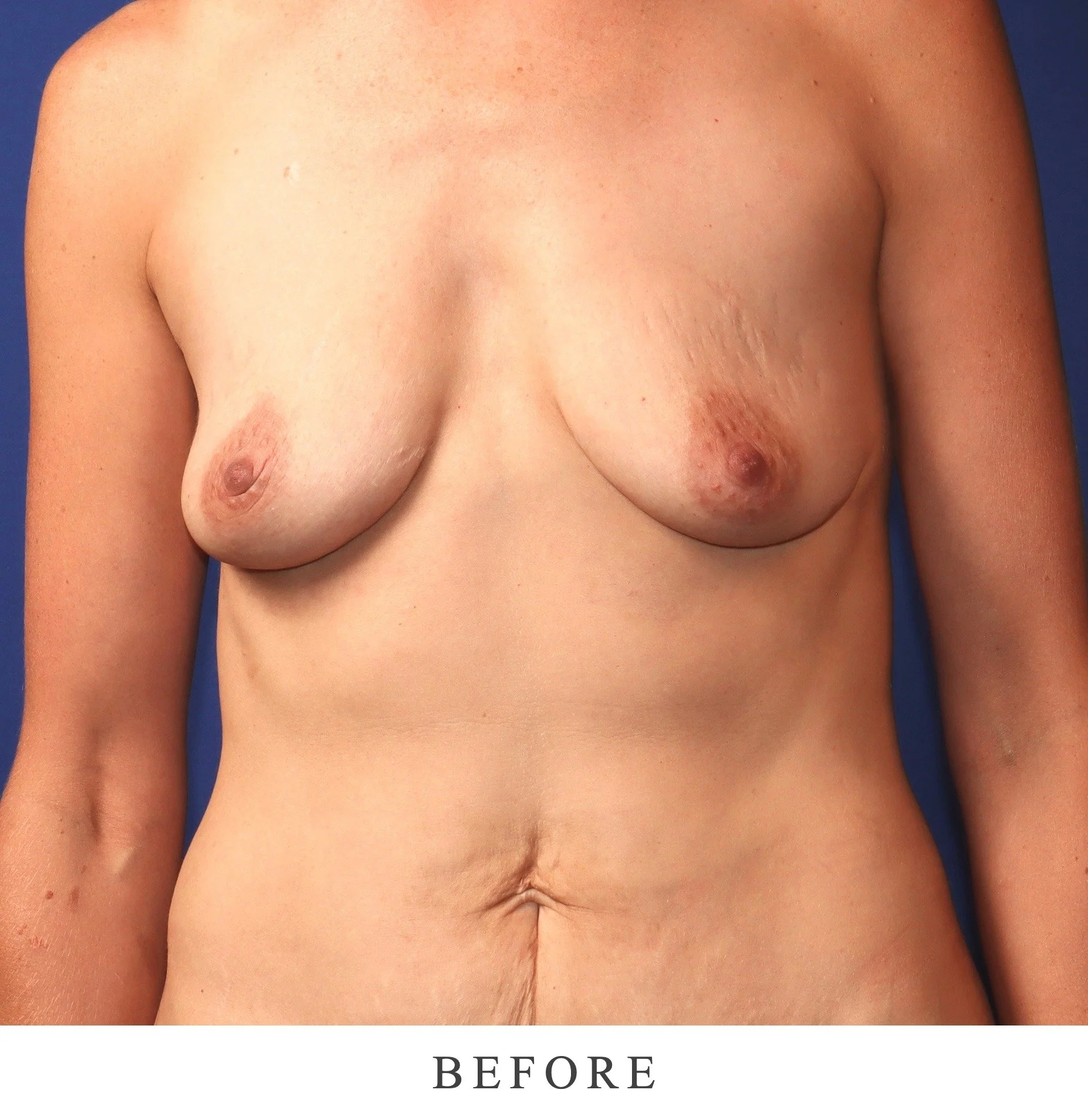 Before photo: frontal torso view against blue background for breast surgery comparison
