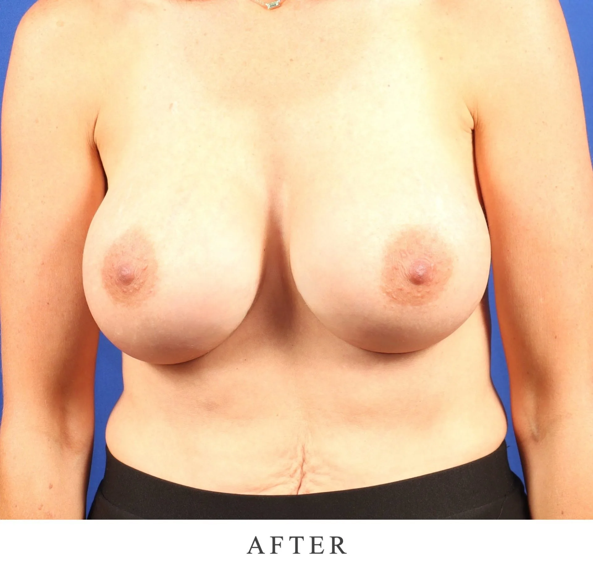 After breast augmentation result showing enhanced volume and symmetry