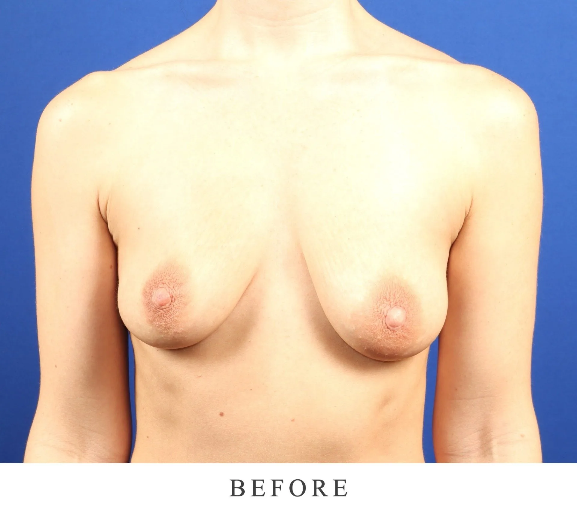 Before photo: front view of patient's chest against blue background
