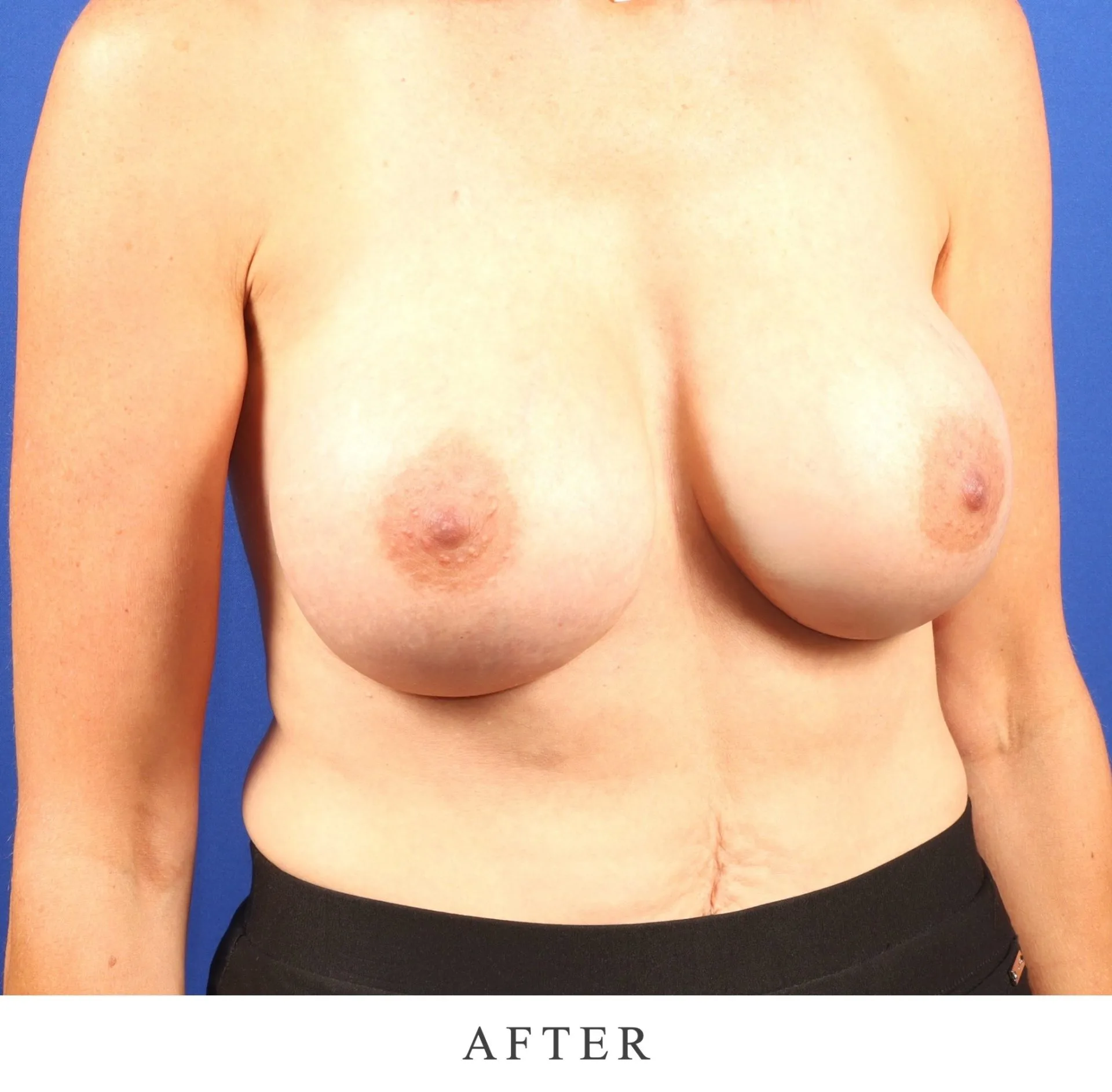 After breast augmentation result showing improved volume and symmetry against blue background
