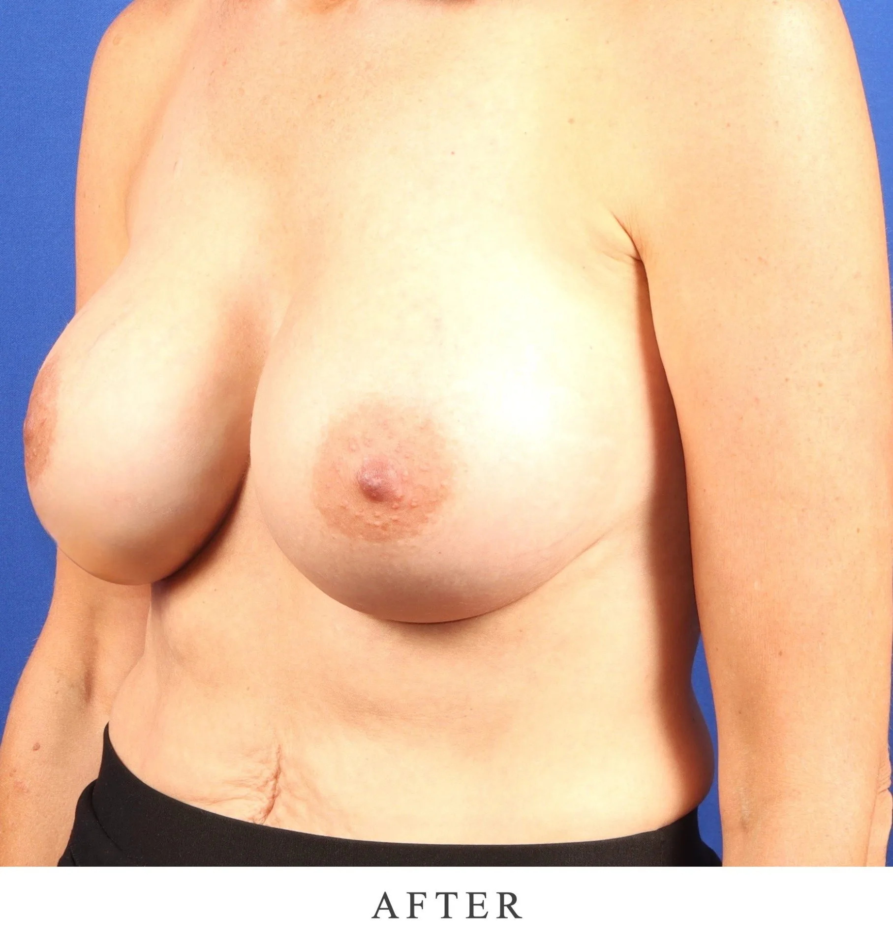 After cosmetic breast surgery result showing improved shape and symmetry