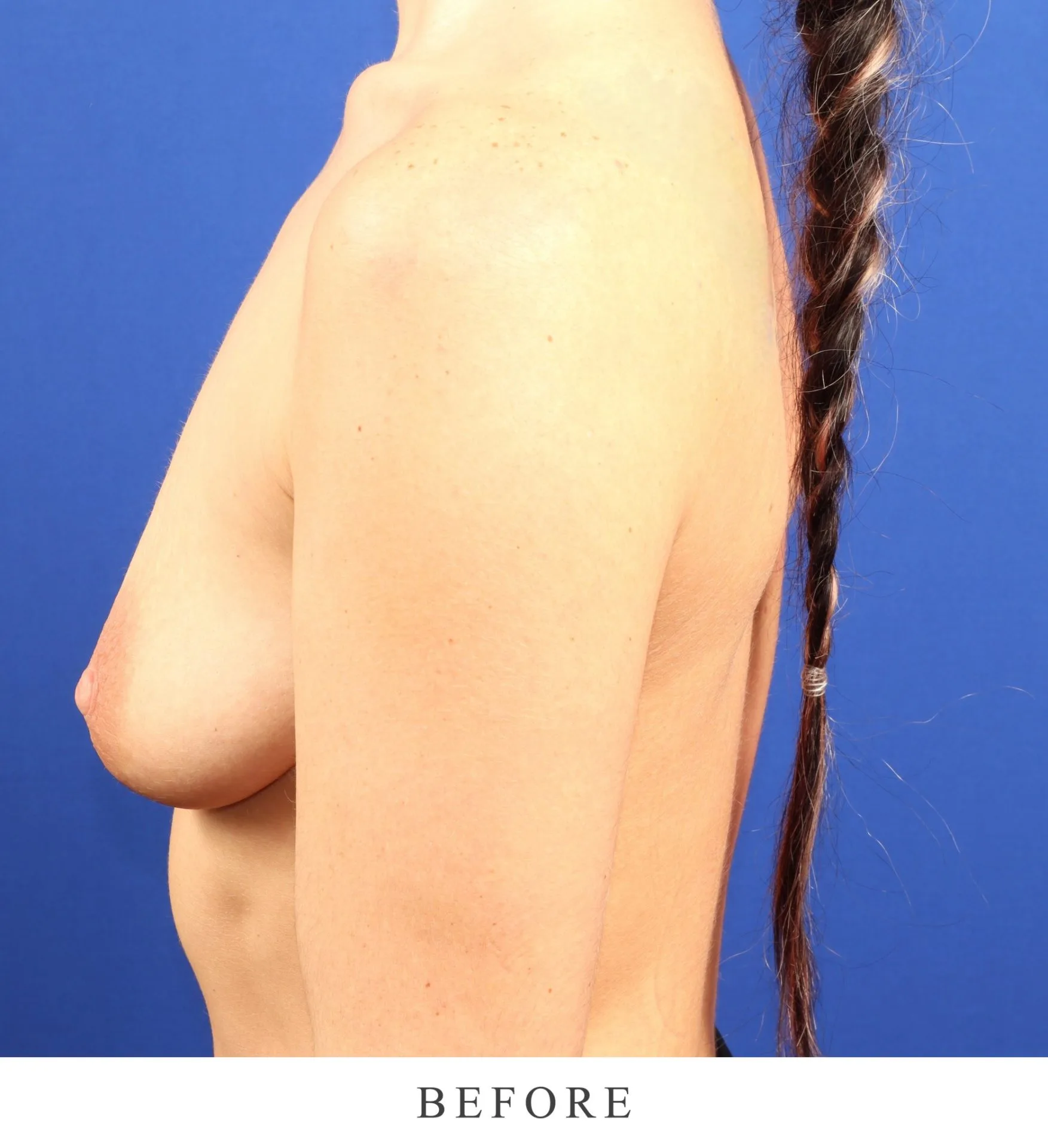 Before photo showing patient's side profile against blue background