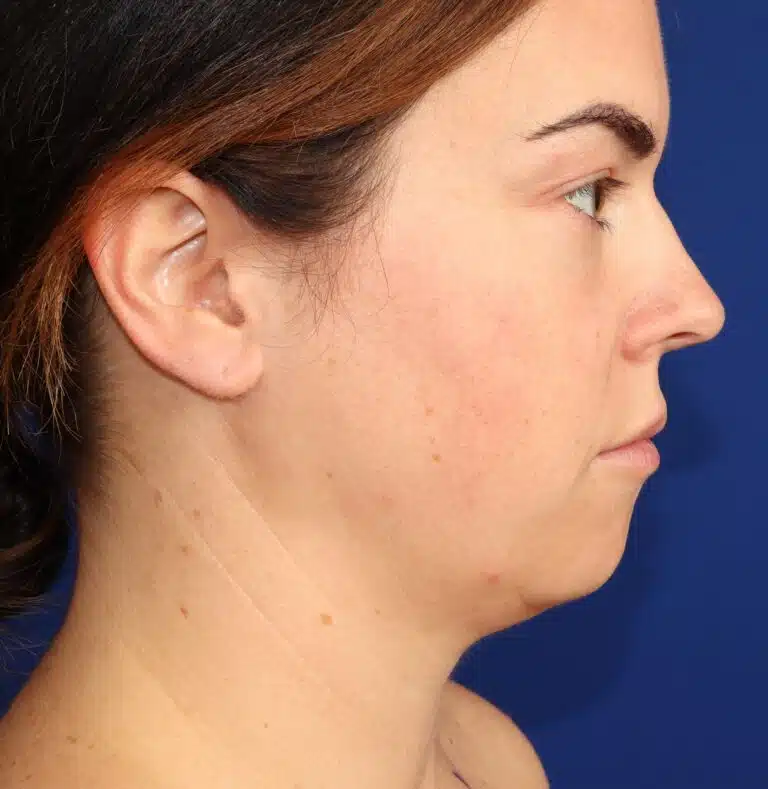 Deep Neck Lift & Chin Implant 1 before