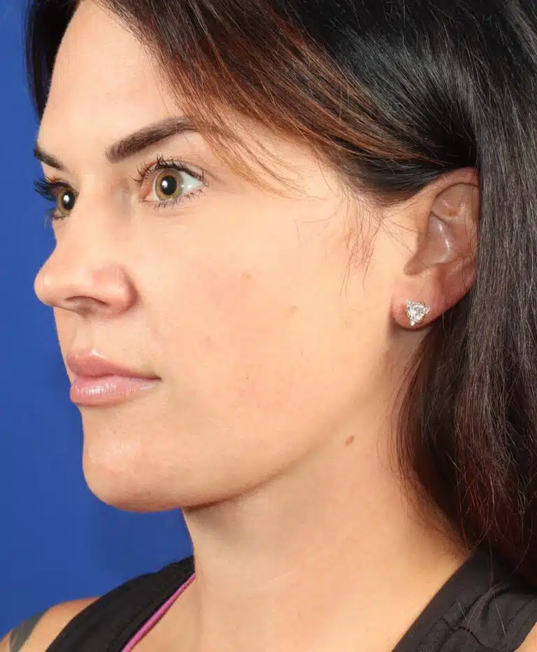 Deep Neck Lift & Chin Implant 1.1 after