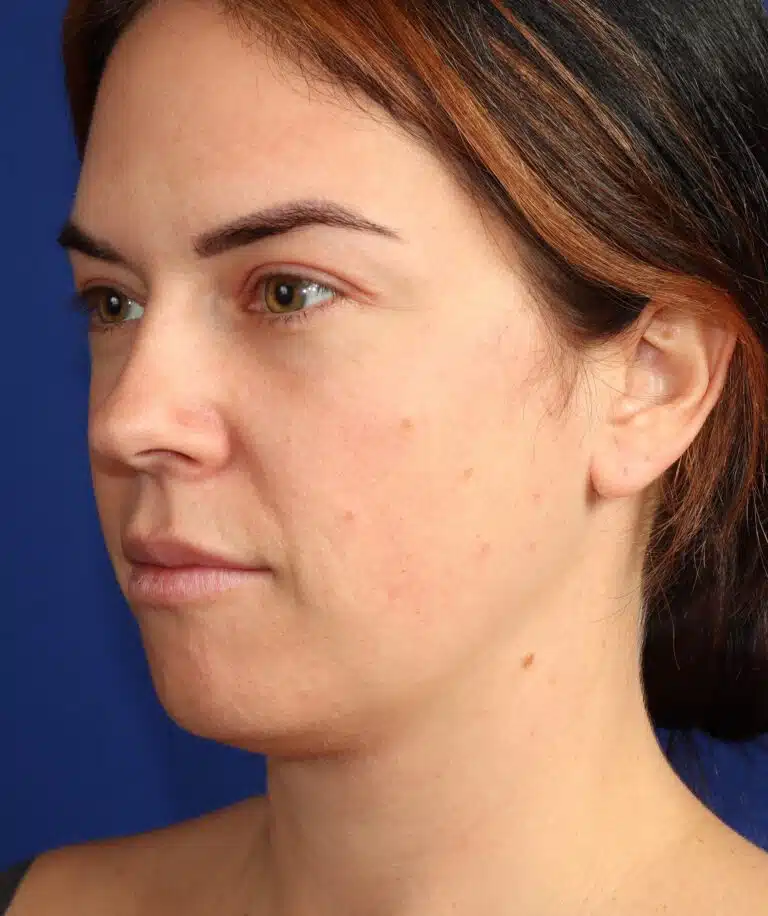 Deep Neck Lift & Chin Implant 1.1 before