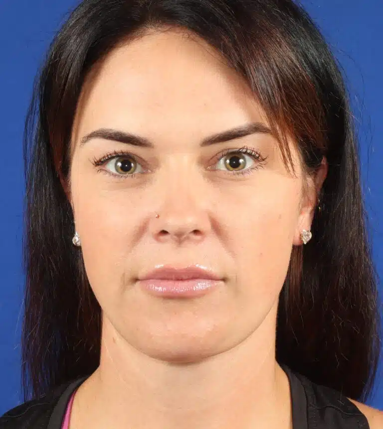 Deep Neck Lift & Chin Implant after