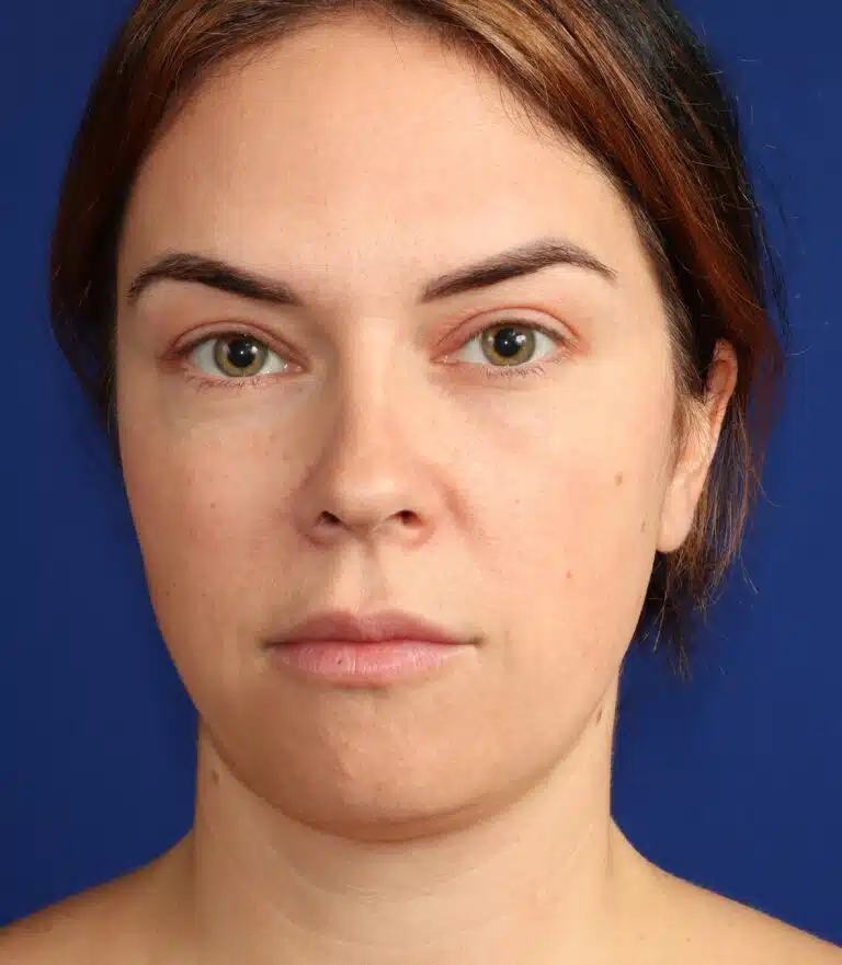 Deep Neck Lift & Chin Implant before