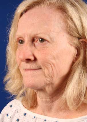 Face Case 1.1 before