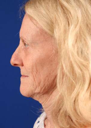 Face Case 1.2 before