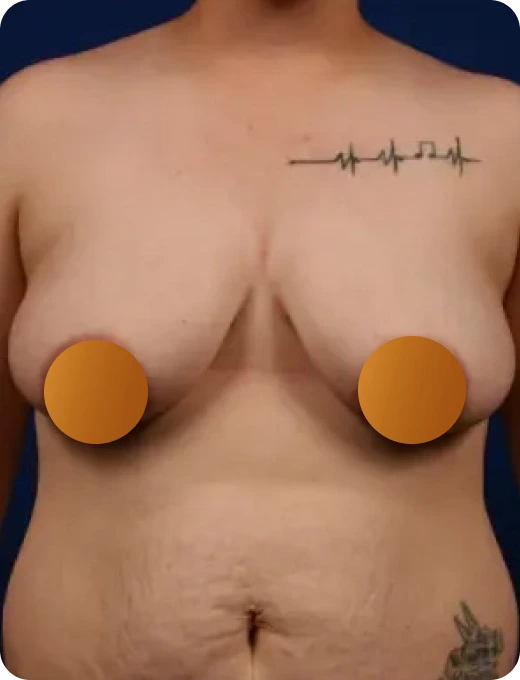 Breast Implant Revision Before & After Banner