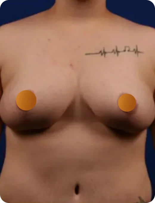 Breast Implant Revision Before & After Banner