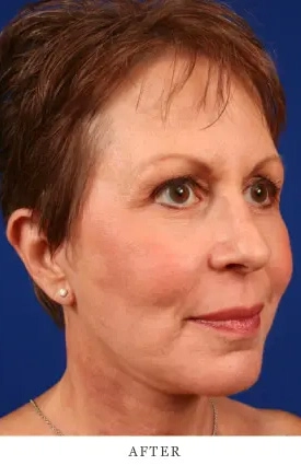 Facelift & Neck Lift Before & After Case 5.1 Results Images