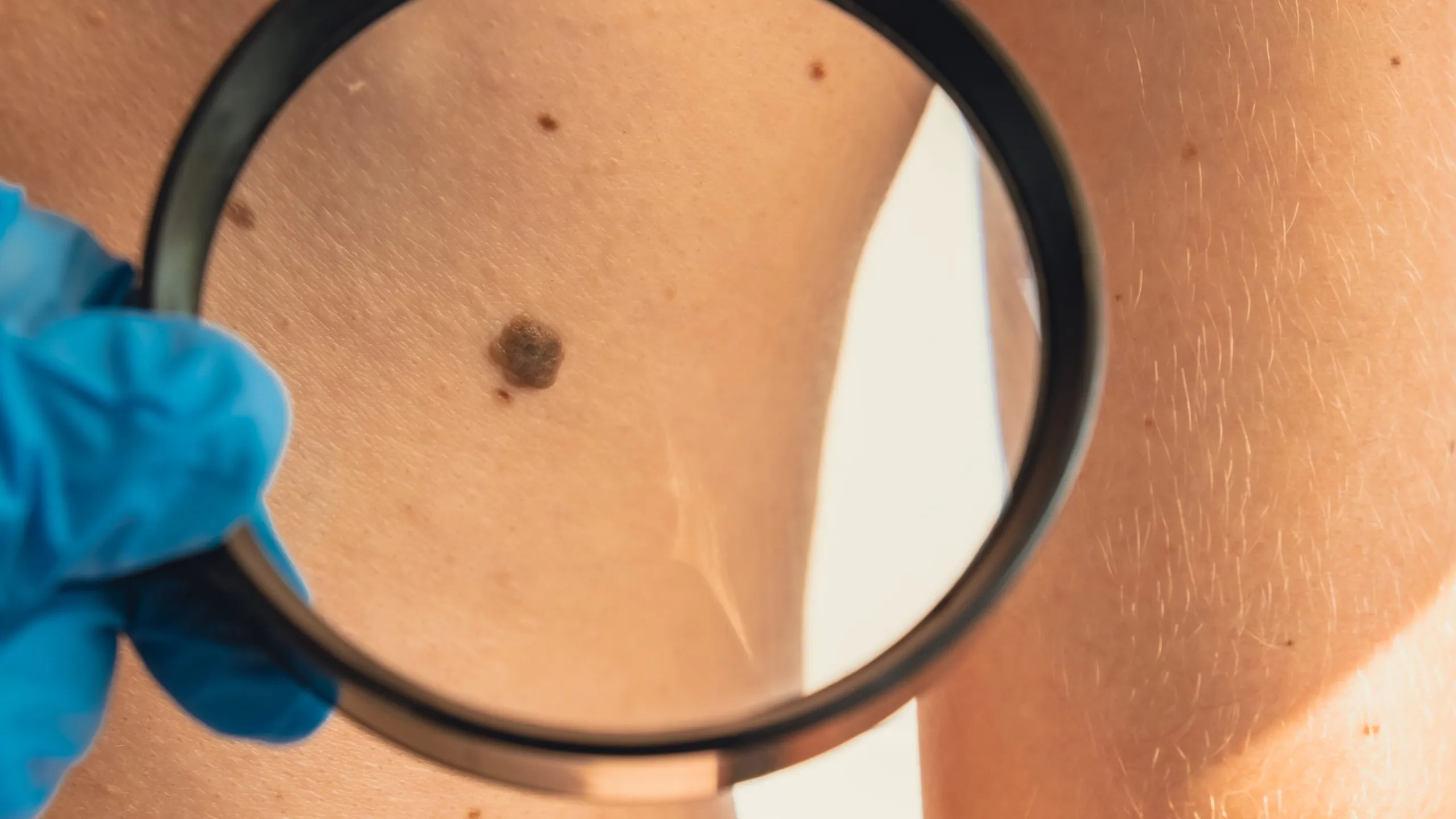 Why Is May Considered Melanoma Awareness Month? Banner