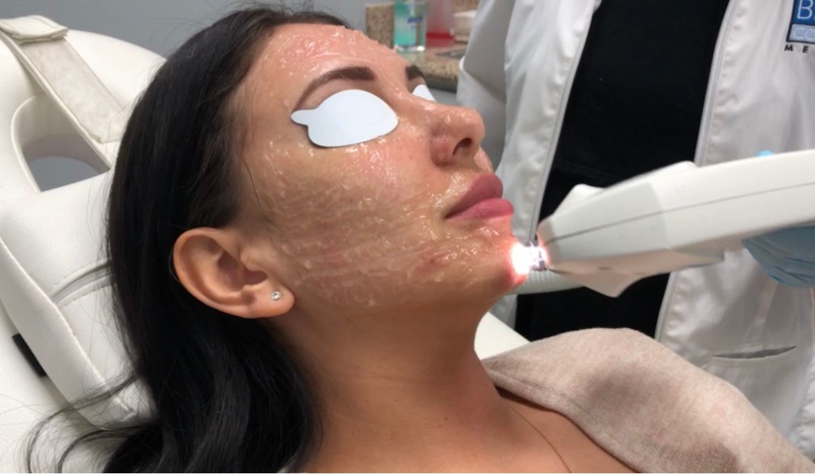 FotoFacial Treatment San Jose, CA Banner