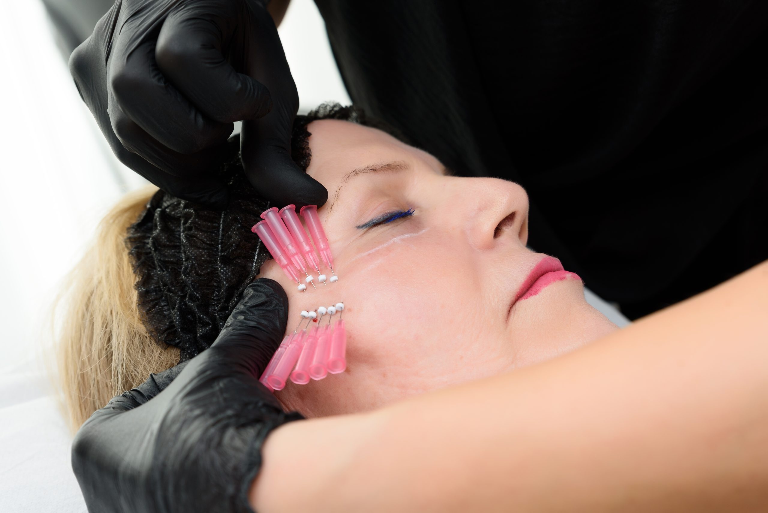 How Do PDO Threads Work? Key Insights for Skin Lifting Banner