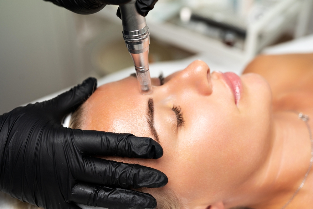 Microneedling San Jose, CA Banner