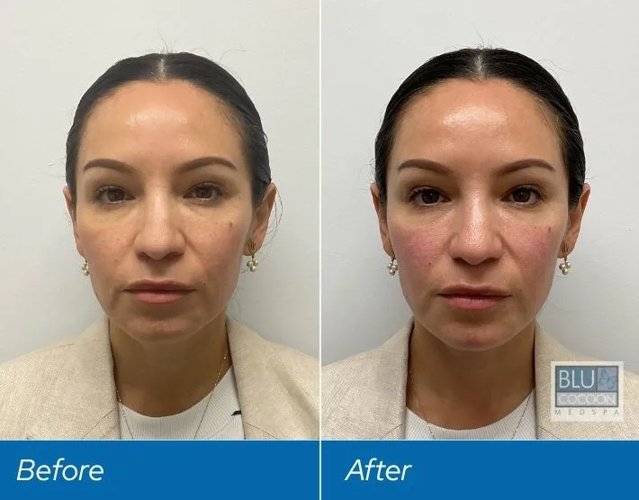Before and after dermal filler treatment showing increased facial volume and cheek definition