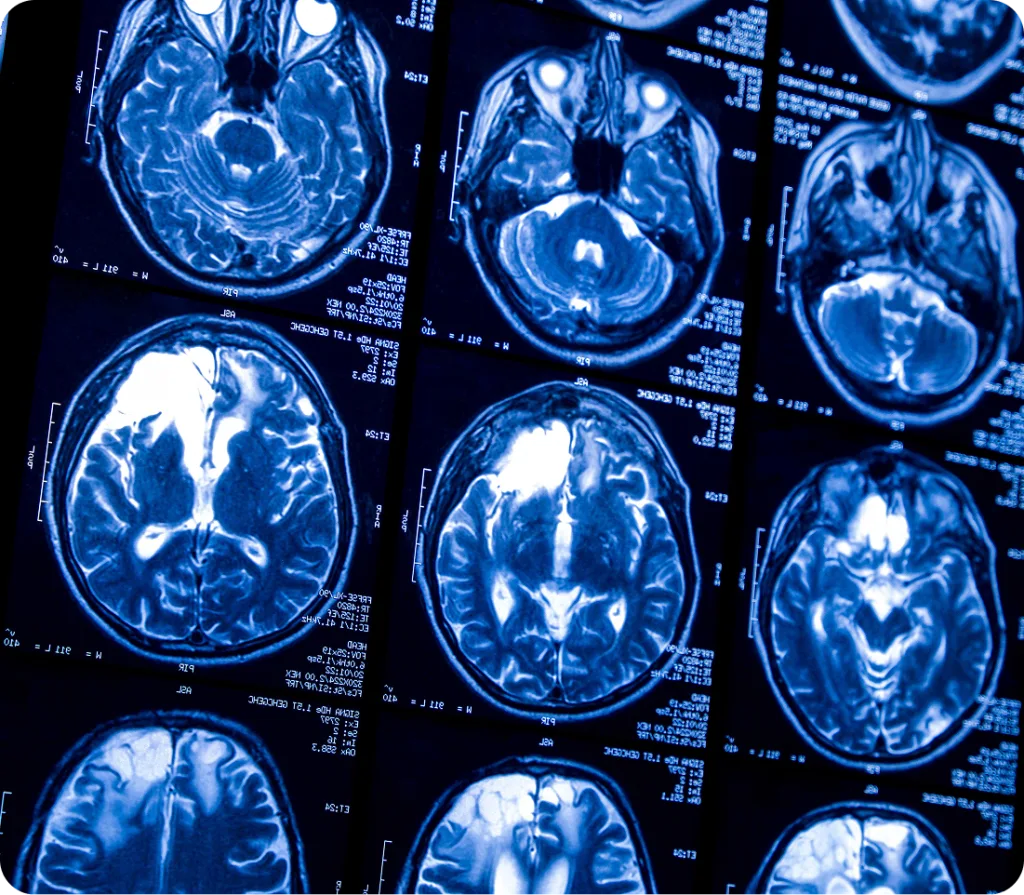 Multiple MRI brain scans displayed showing axial cross-sections in blue and white imaging