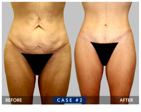 Body lift case 2 before and after