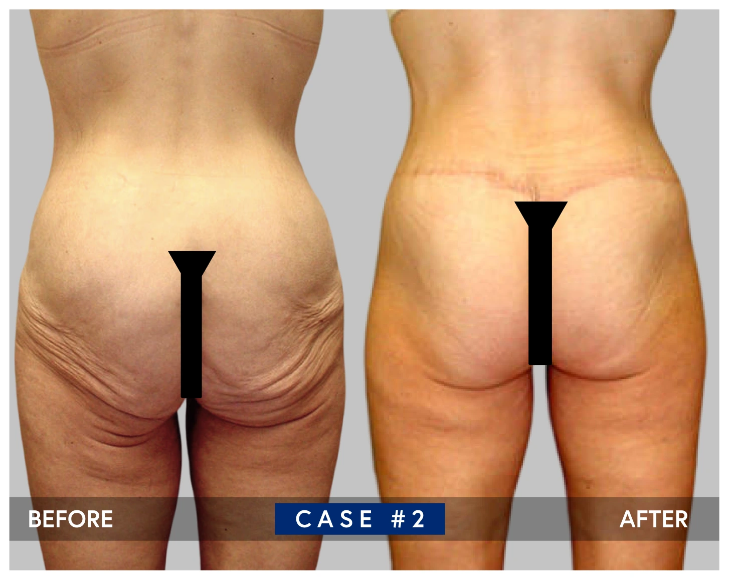 Body lift case 2 before and after
