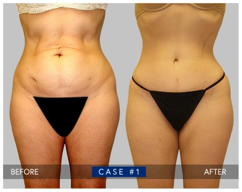 Tummy tuck before and after case showing abdominal contouring results