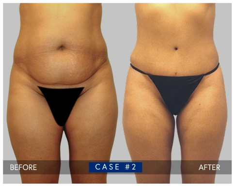 Before and after tummy tuck results showing abdominal contouring and improved waistline definition