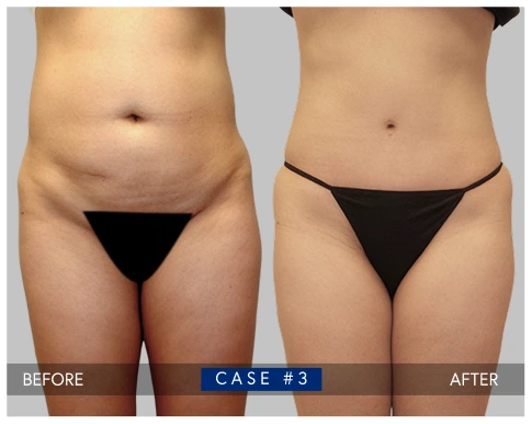 Before and after tummy tuck results showing abdominal contouring and improved midsection definition