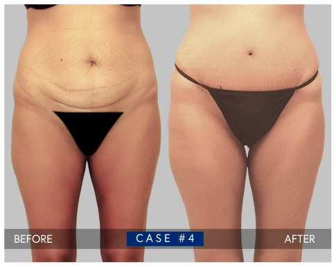 Tummy tuck before and after result showing reduced abdominal skin laxity and improved waistline contour