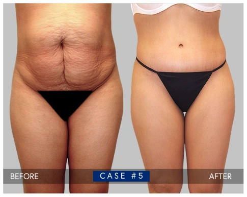 Before and after tummy tuck case showing abdominal contouring results