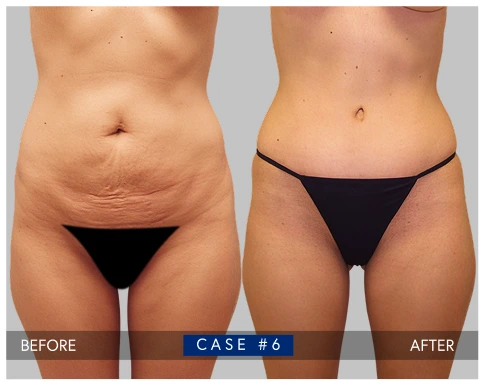 Tummy tuck before and after case #6 showing abdominal contour improvement