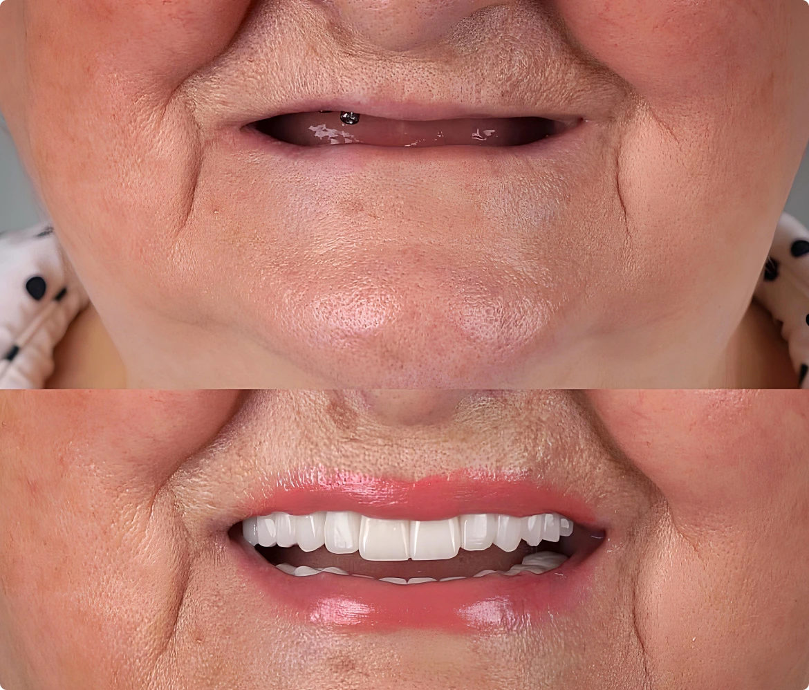 Candidates for Dental Implants Banner