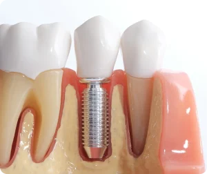 Cross-section model of a dental implant screw between natural teeth
