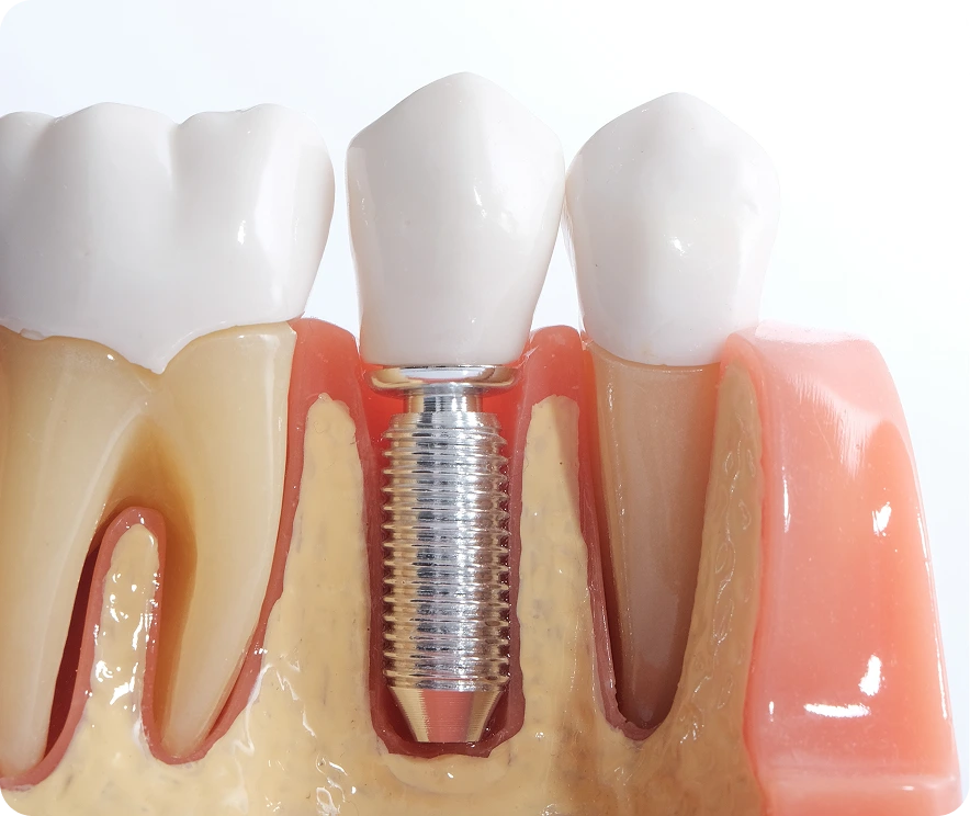 Cross-section model of a dental implant screw between natural teeth