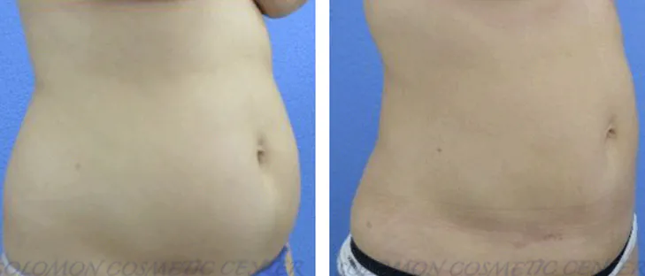 101