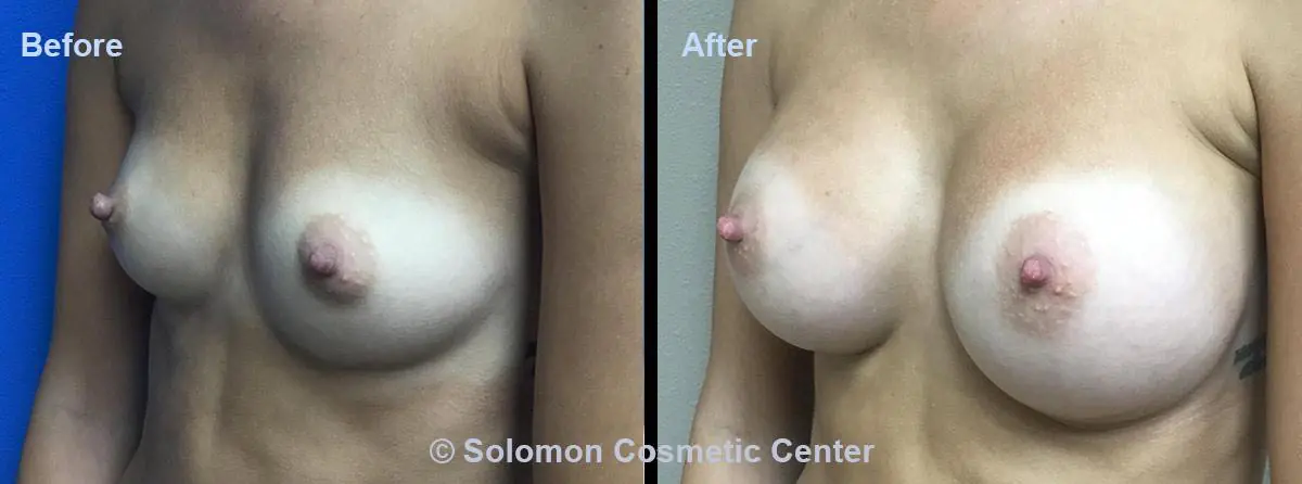 Breast-Augmentation-3