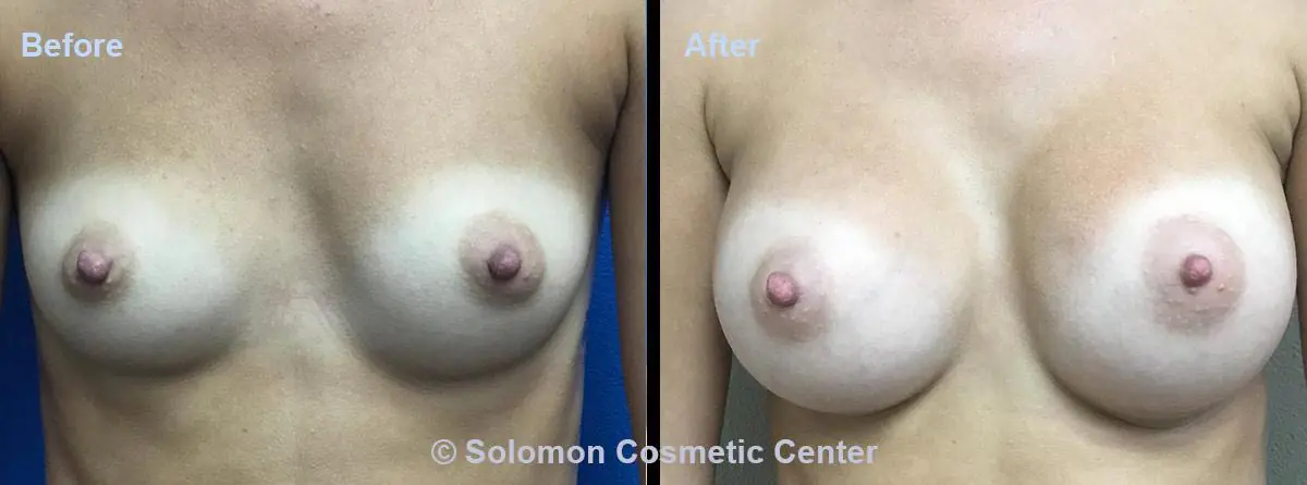 Breast-Augmentation-4
