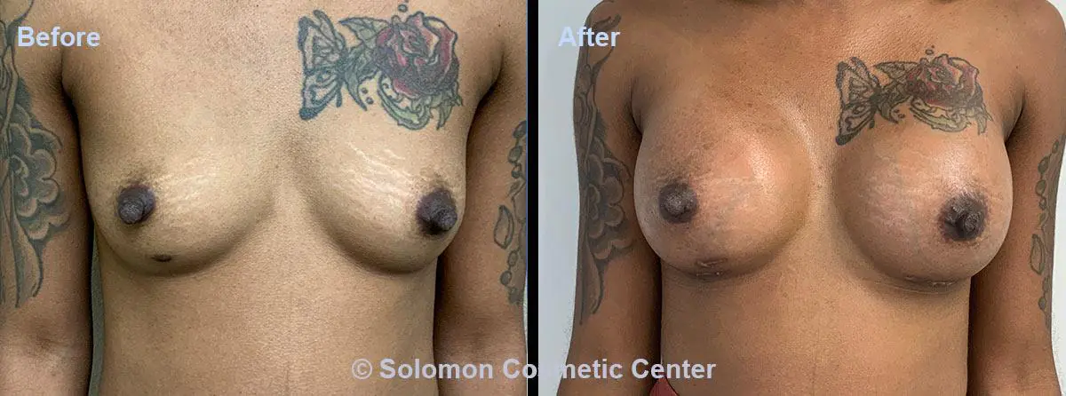 Breast-Augmentation-6