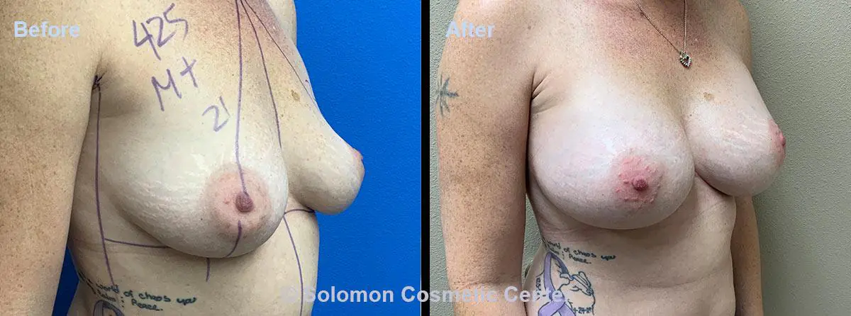 Breast-Augmentation-7