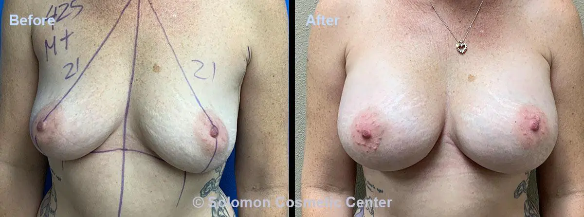 Breast-Augmentation-8