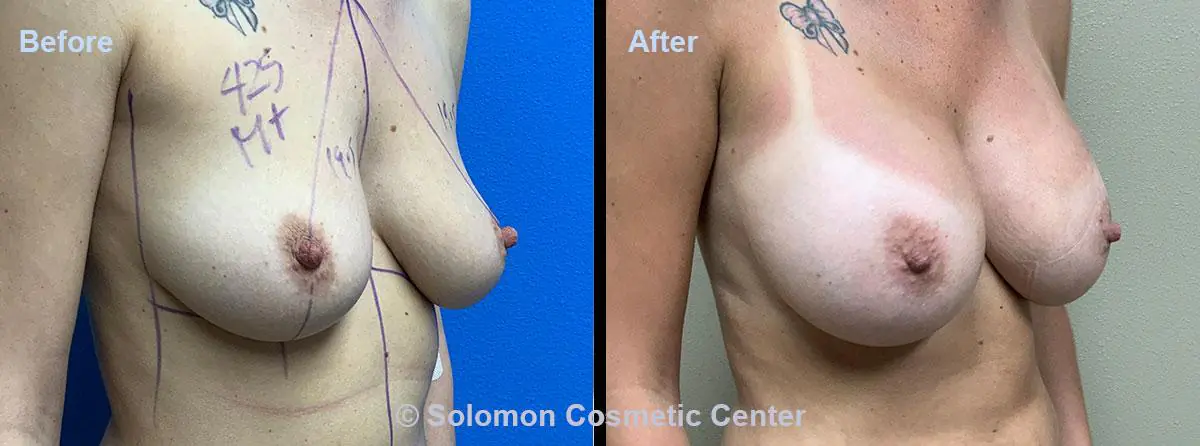 Breast-Augmentation-9
