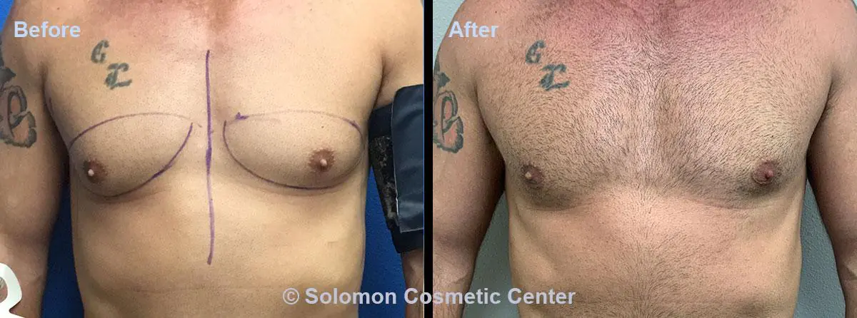 Gynecomastia-1