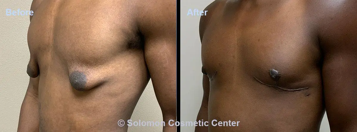 Gynecomastia-4