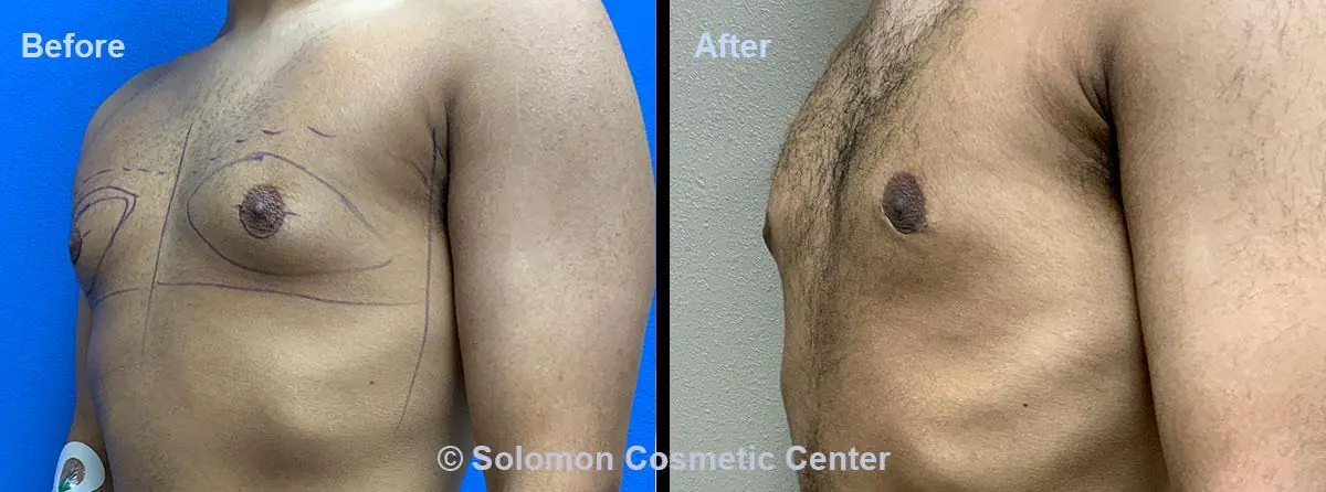 Gynecomastia-7