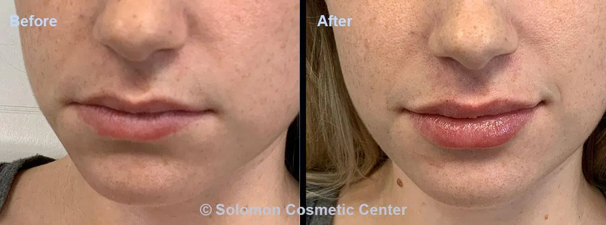 Lip-Filler-2