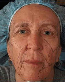 before facial fat Transfer Banner