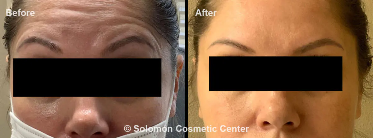 botox3