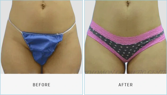 Liposuction Before & After Banner